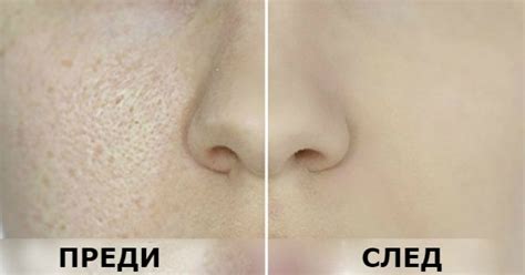 Разширени пори - събрахме за вас най-добрите маски за премахване на ...