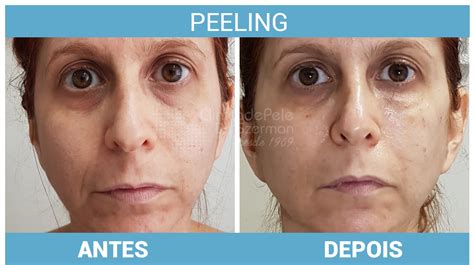 Peeling Facial Antes E Depois