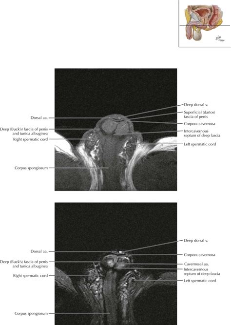 corpora cavernosa