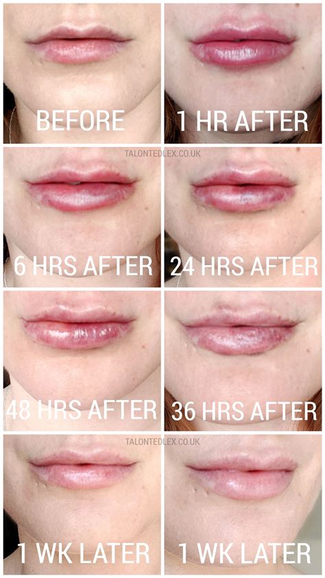 Lip Filler Chart at Harold Chappell blog