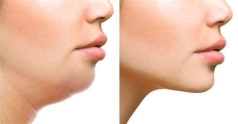 How To Get Rid of a Double Chin | Good Fun Health
