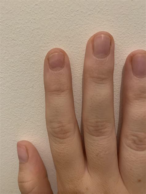 Help! Onycholysis not getting any better! 😥 Details in comments. : r/Nails