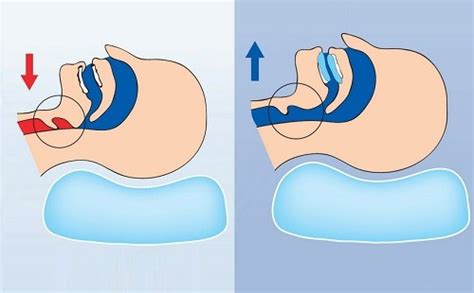 Капа C-ONight (Сонайт) | spiromedical.ru