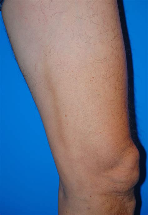 This knot on inside of thigh cause is surprisingly common 33