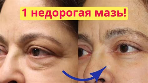 Крем от геморроя от мешков под глазами - мазь от отеков и синяков