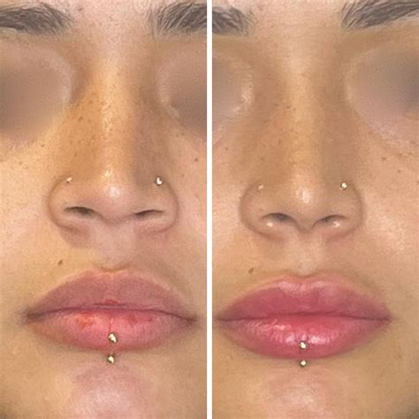 botox nose slimming    guide hubmed