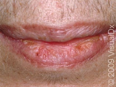 What Is Actinic Cheilitis Look Like - Infoupdate.org