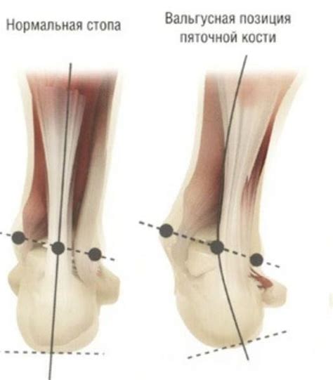Вальгусная деформация стопы: причины, симптомы и лечение в статье ...