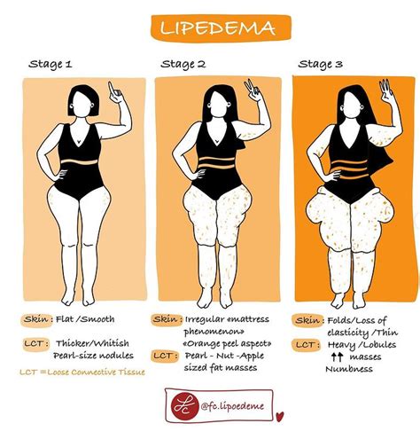 Lipedema – Lipedema Revolution