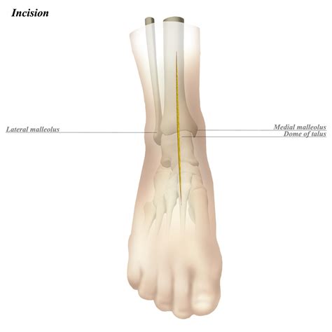 Ankle Anterior Approach - Approaches - Orthobullets