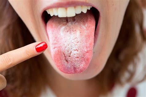 O Que É Bom Para Sapinho Na Língua - Remédio para sapinho: qual a melhor opção? - Blog Dentalclean