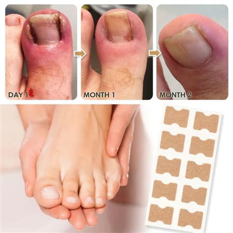 KTS Toenail Correction Stickers, Ingrown Toenail Prevention Stickers ...