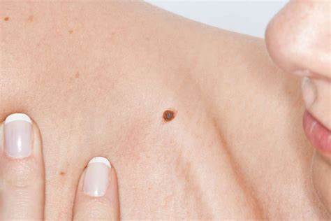 Nei, come riconoscere quelli maligni di cui preoccuparsi - TantaSalute.it