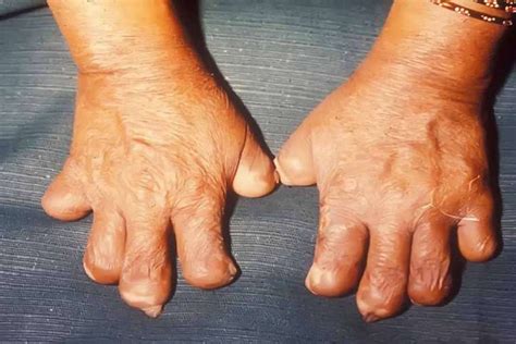 Dầu Đại Phong Tử (Chaulmoogra) Nguyên Chất, Giá Sỉ, Hàng Nhập Khẩu
