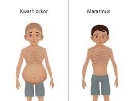 marasmus  kwashiorkor