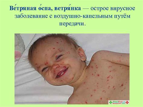 Сестринский уход при ветряной оспе Подготовила Пилипенко Н