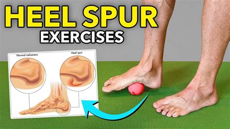 Treatment Heel Spurs Achilles Tendonitis Discount | www.plain-bearing.ru