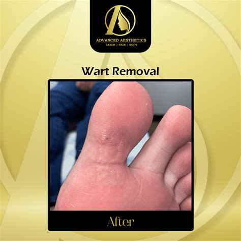 Wart Removal - Advanced Aesthetic Specialist