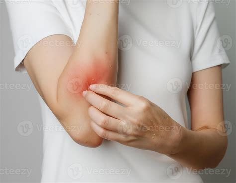 A hand scratching an inflamed rash on the forearm, depicting skin