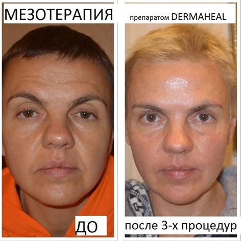 Липолитики для лица: отзывы косметологов, фото до и после, лучшие препараты
