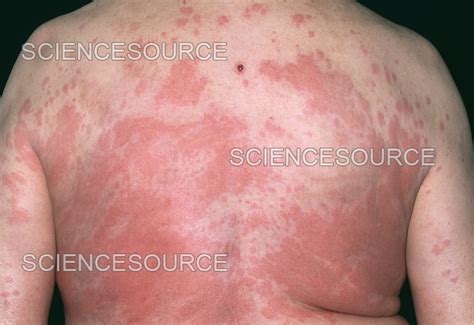 Penicillin allergy | Stock Image - Science Source Images