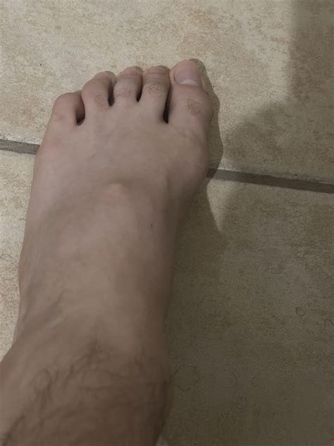 Help? Bump on foot : r/FootFunction