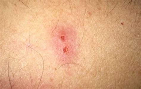 Wolf spider bite: Symptoms, treatment, and prevention