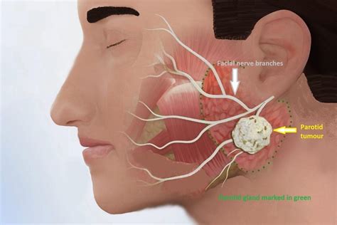 Fundraiser by Jizet Sionit : Johnny's Parotid Gland Tumor Removal Surgery