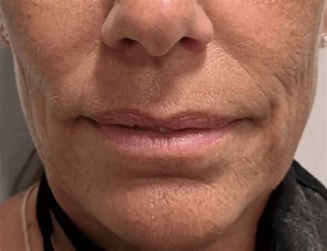 Microneedling - Mountcastle Medical Spa and Laser Center