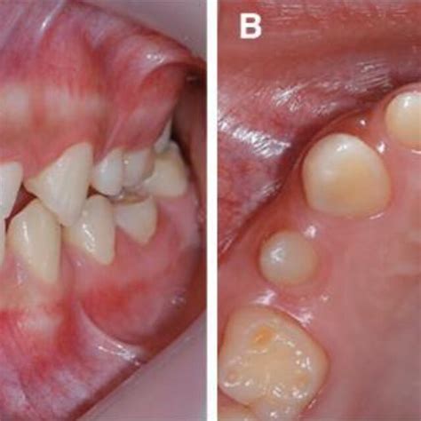 The general appearance of teeth with Microdontia (A) Frontal view, (B ...