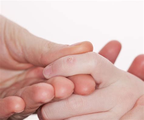 The truth about warts