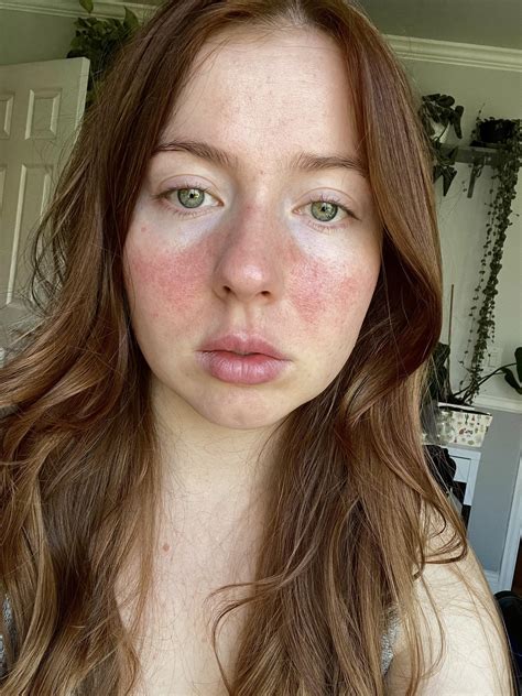 Rosacea Laser Treatment Bruising
