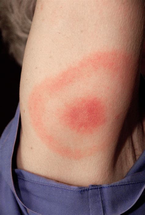 Erythema migrans - DocCheck