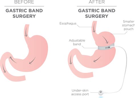 gastric band dr john makipour
