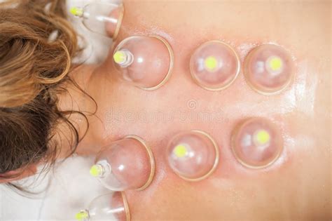 vacuum cups  medical cupping therapy   womans  stock photo