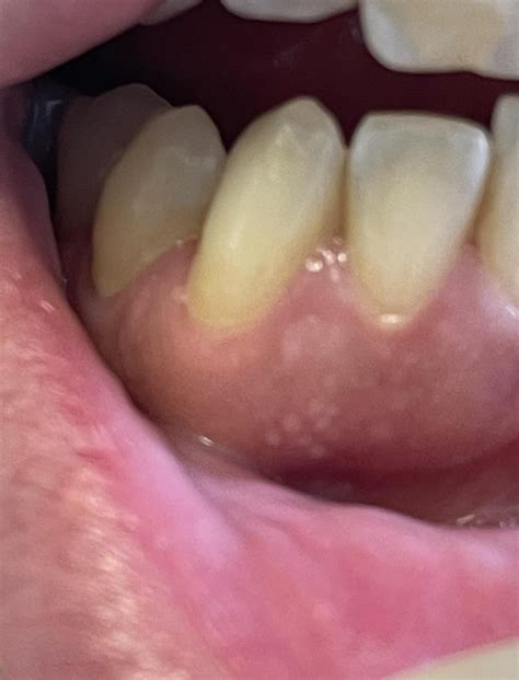 White patch and bumps on gums : r/PeriodontalDisease