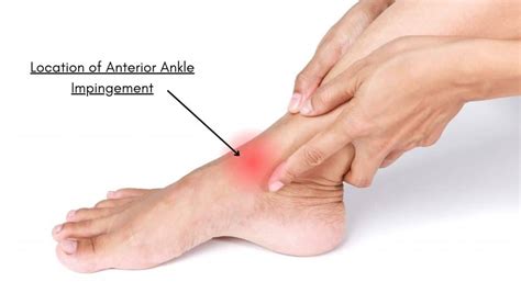 Anterior Ankle Impingement: Symptoms, Causes and Treatment