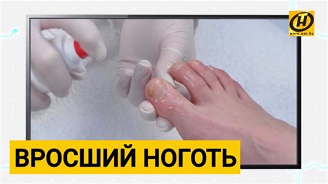 Вросший ноготь, что делать? Формула Здоровья - YouTube