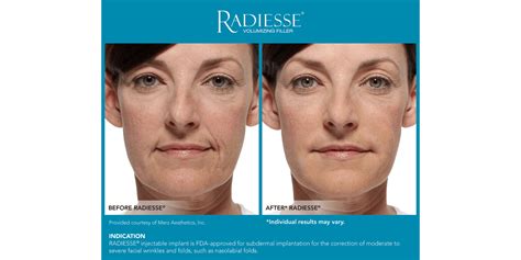 Radiesse Treatment Gallery | Chicago Skin Clinic | Patient Results