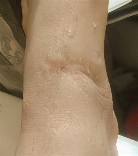 EHL Tendon Laceration (Healing Progression) : r/InjuriesAndWounds