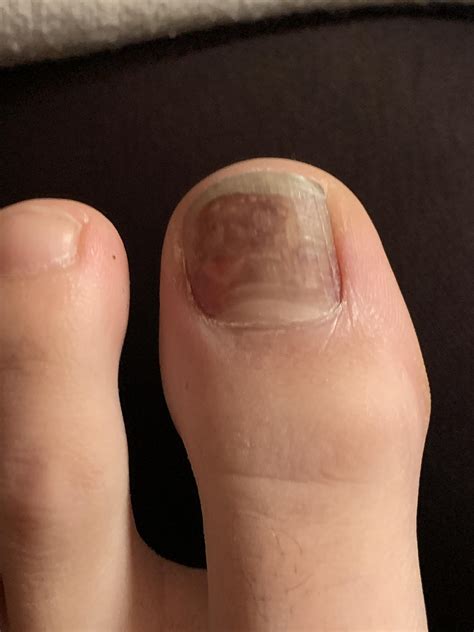 Bruised my toe skiing 3 weeks ago, was black and hurt but now it feels