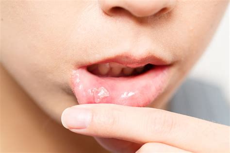 Stomatiti aftose - Studio Dentistico Torino