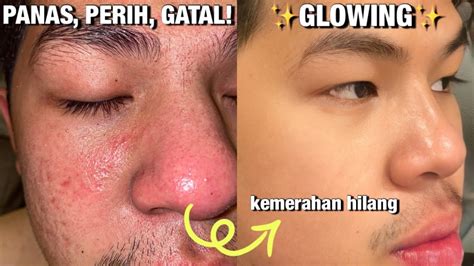 penyebab tips atasi kulit wajah iritasi sampai panas perih gatal
