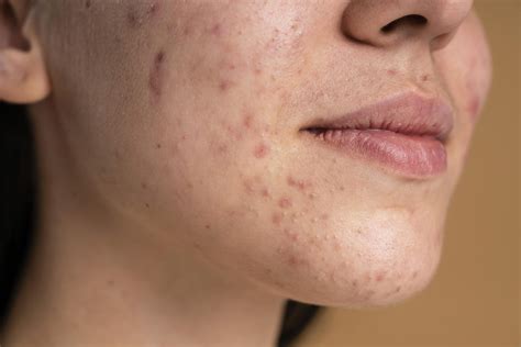 Clascoterone Cream | Hormonal Acne Treatment | EHA
