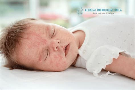 Bebe Com Alergia A Ovo - Tipos De Alergia: Saiba Como Identificar E Tratar Os Sintomas – TTDMF