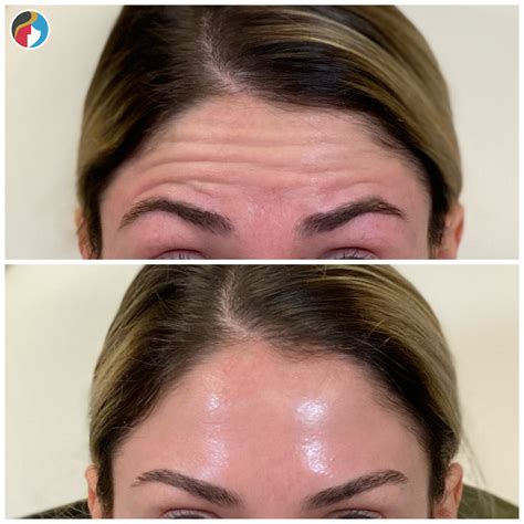 Botox Treatment | Syracuse, Albany, Rochester, New Hartford