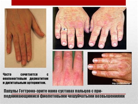 Идиопатические воспалительные миопатии: клиника, диагностика и лечение ...
