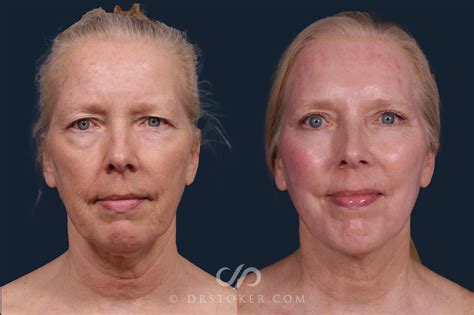 laser treatment face cost 6