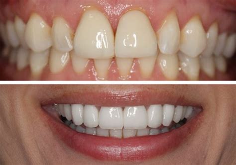 how to fix black triangles in teeth