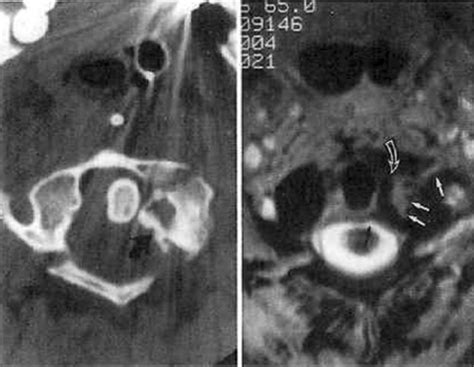 Magnetic resonance imaging of the transverse atlantal ligament for the ...